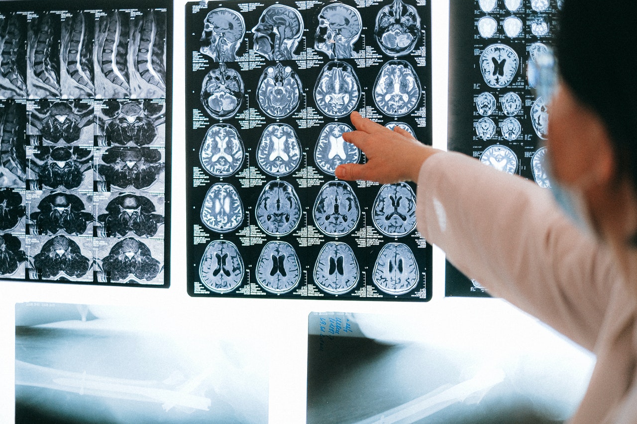 Epilepsy Stroke Multiple Sclerosis
